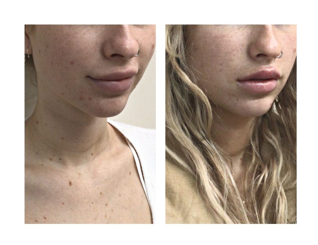 Safe and Natural Methods to Support Dermal Filler Dissolution at Home Safe and Natural Methods to Support Dermal Filler Dissolution at Home