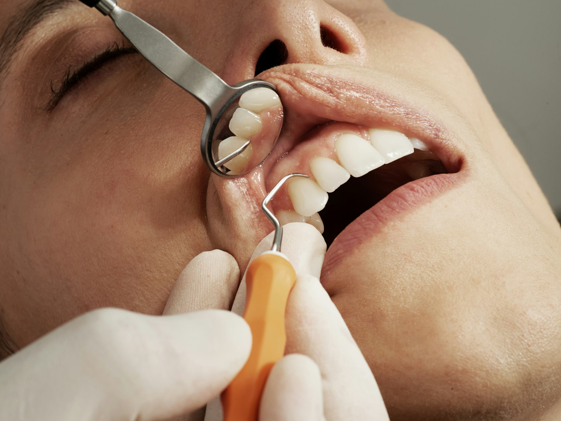 Understanding Insurance Coverage for Wisdom Teeth Removal: What You Need to Know